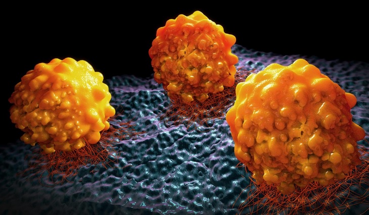 La pression des lipides associés à l'obésité sur les cellules cancéreuses, pourrait les rendreplus agressives et plus susceptibles de former de véritables tumeurs (Visuel Fotolia).