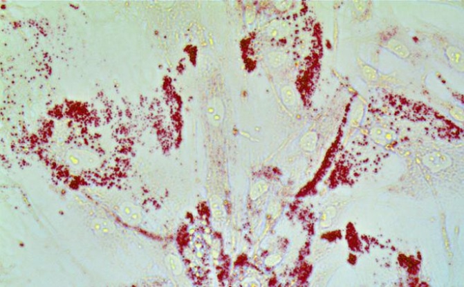 Une protéine, CAVIN1, régale de lipides les cellules cancéreuses et alimente ainsi la propagation du cancer de la prostate (Visuel Nick (Jin-Yih) Low)