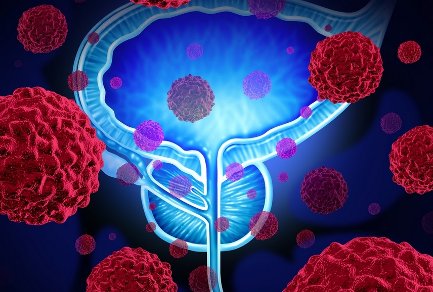 Le cancer de la prostate peut récidiver après une thérapie de privation hormonale  (Visuel Weill Cornell Medicine) 