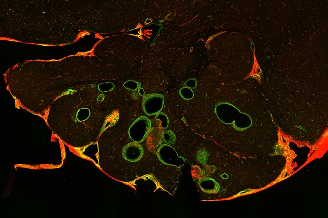 Les malformations caverneuses cérébrales (CCM), également appelées angiomes caverneux ou cavernomes, sont des lésions vasculaires sur les vaisseaux sanguins du cerveau (Visuel Joppe Oldenburg)
