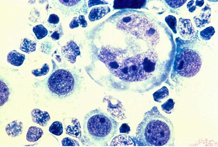 Pour rester intègres, en cas de dommage à la membrane, les cellules cancéreuses utilisent une technique complexe,  une forme de macropinocytose (Visuel Fotolia)