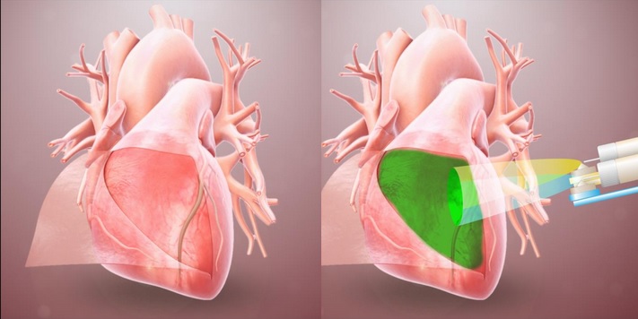 Un hydrogel qui forme une barrière pour empêcher le tissu cardiaque d'adhérer aux tissus environnants après une chirurgie (Visuel Université de Californie - San Diego) 