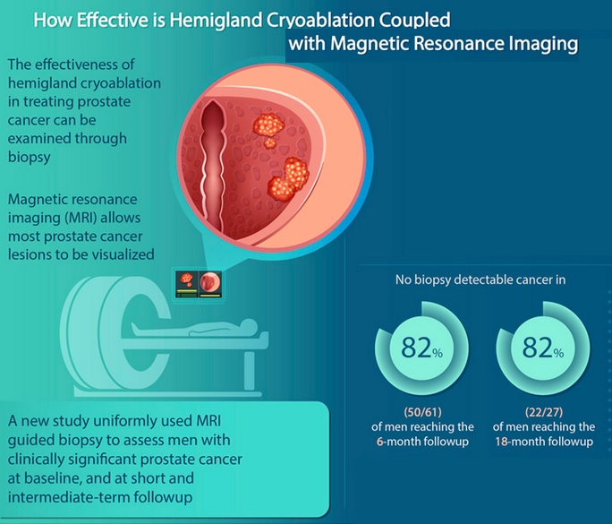 Ici, une élimination de la tumeur est constatée par biopsie chez 82% des participants ayant subi ce mode de cryoablation (HGCryo) (Visuel UCLA)
