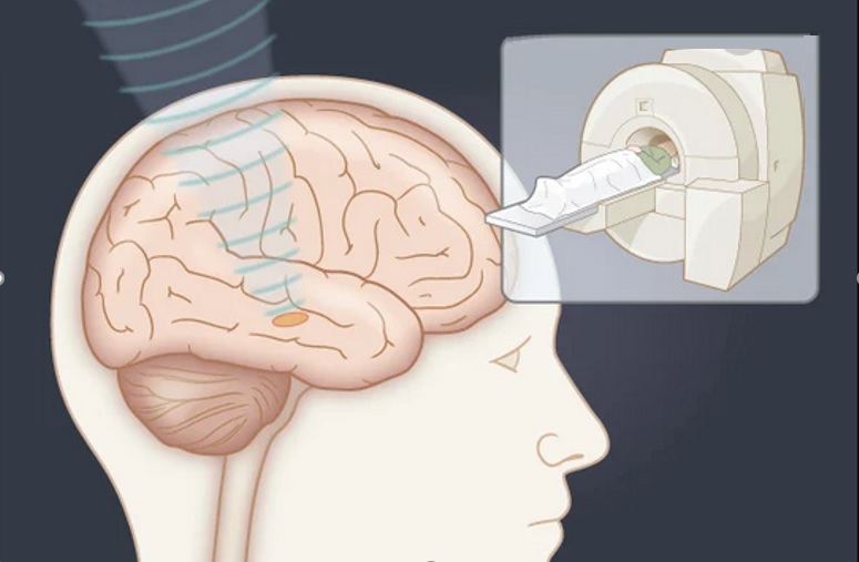 L'équipe de l'UVA Health utilise ces ultrasons focalisés chez les patients présentant des symptômes de la maladie de Parkinson beaucoup plus graves d'un côté du corps (Visuel UVA Health)