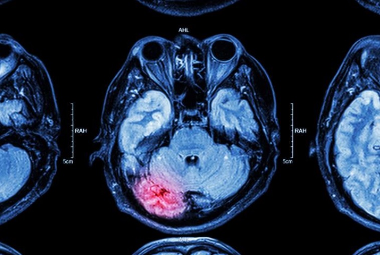 L'intervention consiste à supprimer les nouveaux neurones formés à la suite d'une crise. 