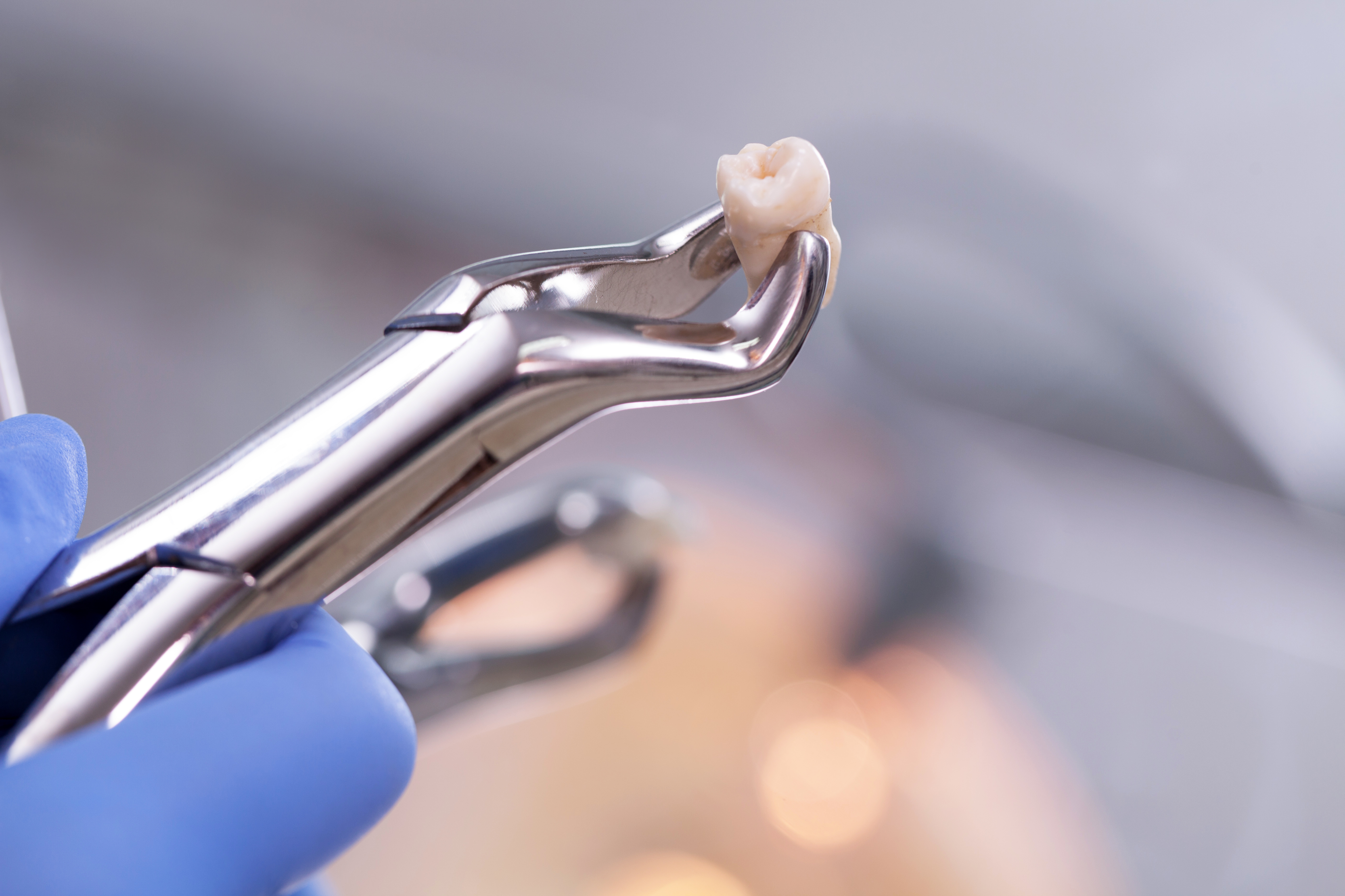 Les patients qui ont reçu des opioïdes après une extraction dentaire signalent des niveaux de douleur bien pire Les patients qui ont reçu des opioïdes après une extraction dentaire signalent des niveaux de douleur bien pire