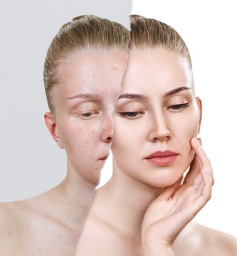 L'acné est liée à un risque très accru de dépression