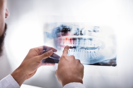 La perte de dents serait-elle-même facteur important dans le développement de l'hypertension (HTA) ? 