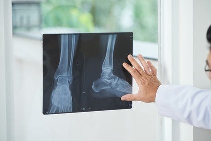 Si le patient est capable de peser sur sa cheville et qu'il n'y a aucune preuve radiographique d'atteinte deltoïdienne, la blessure à la cheville est généralement stable et ne nécessite aucune intervention chirurgicale Si le patient est capable de peser sur sa cheville et qu'il n'y a aucune preuve radiographique d'atteinte deltoïdienne, la blessure à la cheville est généralement stable et ne nécessite aucune intervention chirurgicale