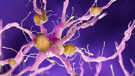Le virus de l'herpès simplex de type 1 (VHS-1) -responsable de l'herpès labial- est à nouveau invoqué comme cause de la maladie d'Alzheimer. Le virus de l'herpès simplex de type 1 (VHS-1) -responsable de l'herpès labial- est à nouveau invoqué comme cause de la maladie d'Alzheimer.