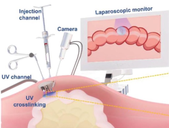 Ce gel chirurgical, adhésif et injectable, permet de prévenir les tissus cicatriciels ou les adhérences post-chirurgicales après une chirurgie mini-invasive (Visuel Yaobin Wu, Guangdong Engineering Research Center for Translation of Medical 3D Printing Application)