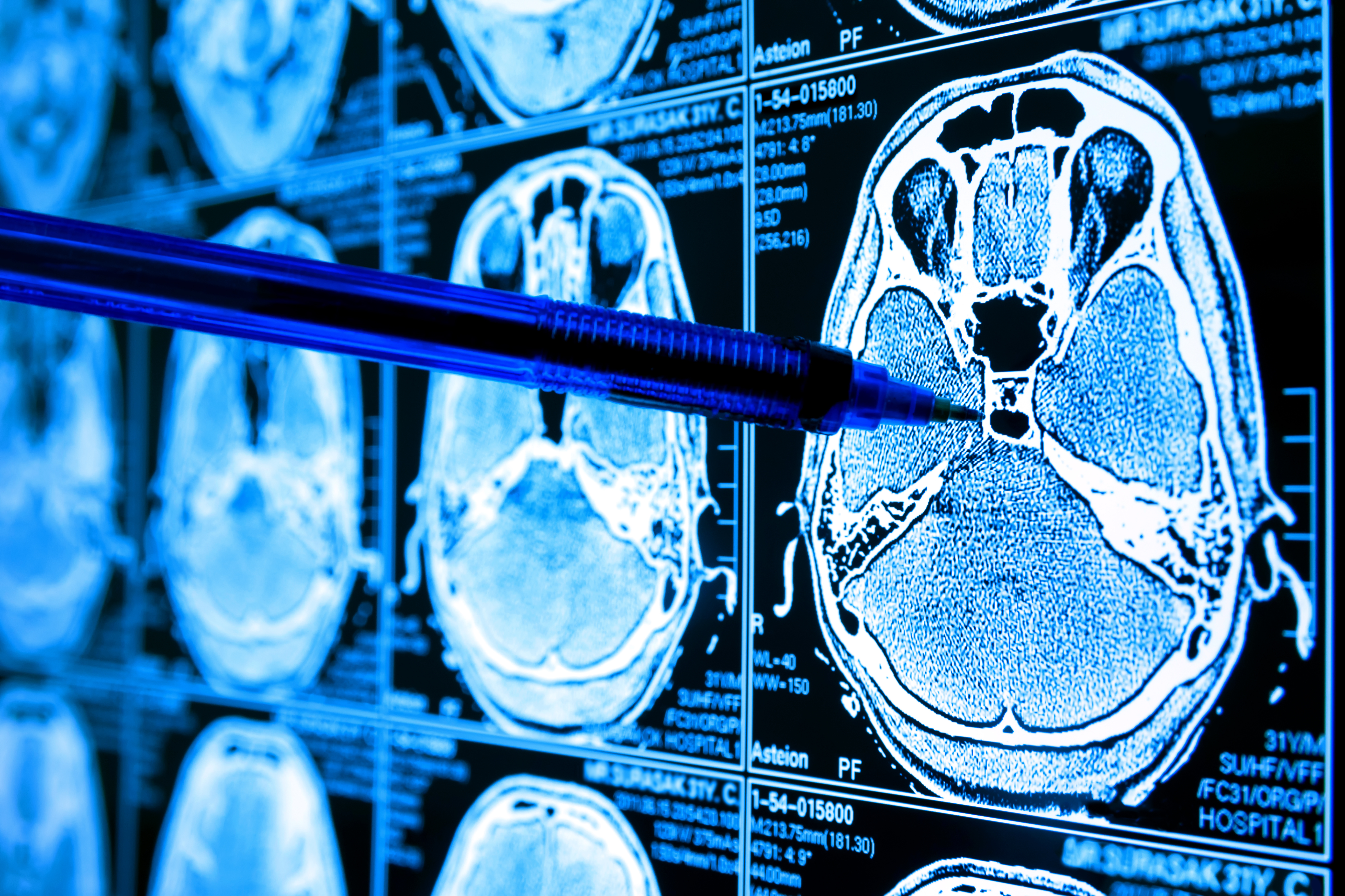 Ces résultats préliminaires d'essai clinique de phase I, publiés dans le New England Journal of Medicine font état d’une régression « spectaculaire et rapide » du glioblastome (GMB) après une thérapie CAR-T de nouvelle génération (Visuel Adobe Stock 221723157)