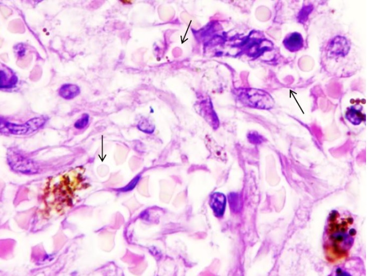 Cette attaque massive des globules rouges entraînerait des dommages aux neurones cérébraux, aux vaisseaux sanguins et aux organes internes, dont la fibrose pulmonaire serait l’une des manifestations les plus évidentes mais pas la seule (Visuel FEFU press office)