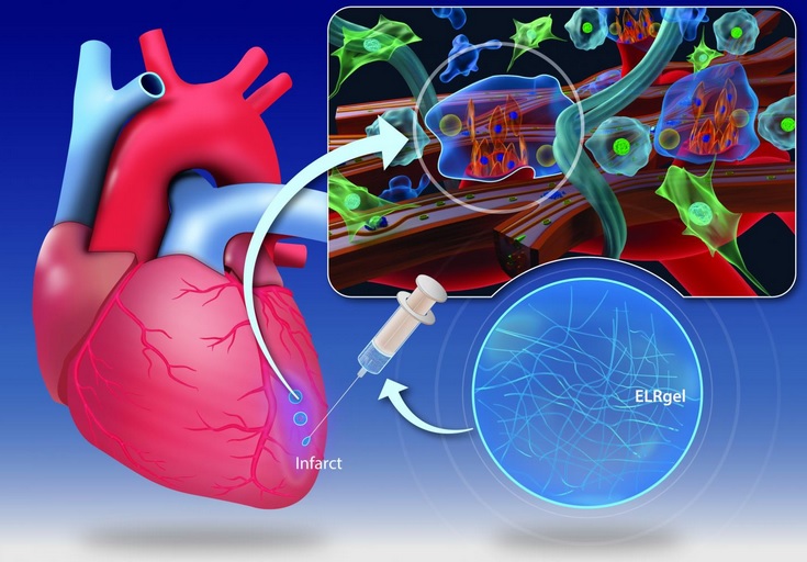 Cette injection d'hydrogel pourrait changer la façon dont le muscle cardiaque guérit après une crise cardiaque (Visuel CÚRAM, National University of Ireland Galway)