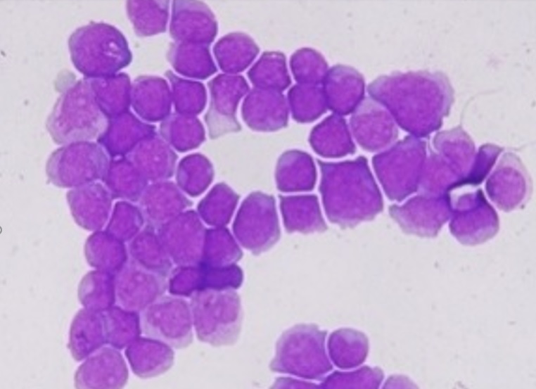 Des mutations dans 2 gènes, TET2 et DNMT3A, spécifiques à la leucémie, viennent d’être associées à la létalité synthétique, un processus par lequel 2 mutations combinées induisent la mort cellulaire (Visuel Fotolia) Des mutations dans 2 gènes, TET2 et DNMT3A, spécifiques à la leucémie, viennent d’être associées à la létalité synthétique, un processus par lequel 2 mutations combinées induisent la mort cellulaire (Visuel Fotolia)
