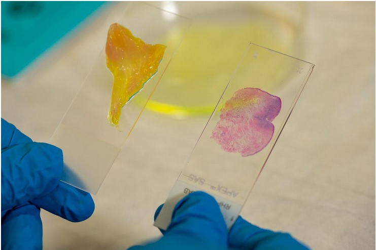 Combiner à la microscopie un système d’apprentissage en profondeur, un type d’application de l’intelligence artificielle (IA), permet une vérification des marges du cancer en quelques minutes seulement (Visuel Brandon Martin/Rice University) Combiner à la microscopie un système d’apprentissage en profondeur, un type d’application de l’intelligence artificielle (IA), permet une vérification des marges du cancer en quelques minutes seulement (Visuel Brandon Martin/Rice University)