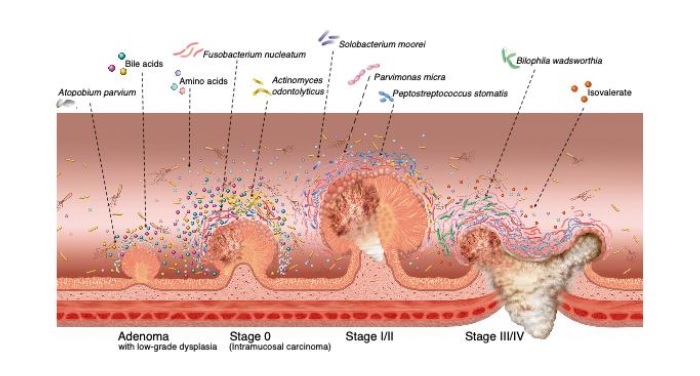 L’intestin « le sent bien » : certains changements du microbiome intestinal peuvent être des signes précoces du cancer colorectal