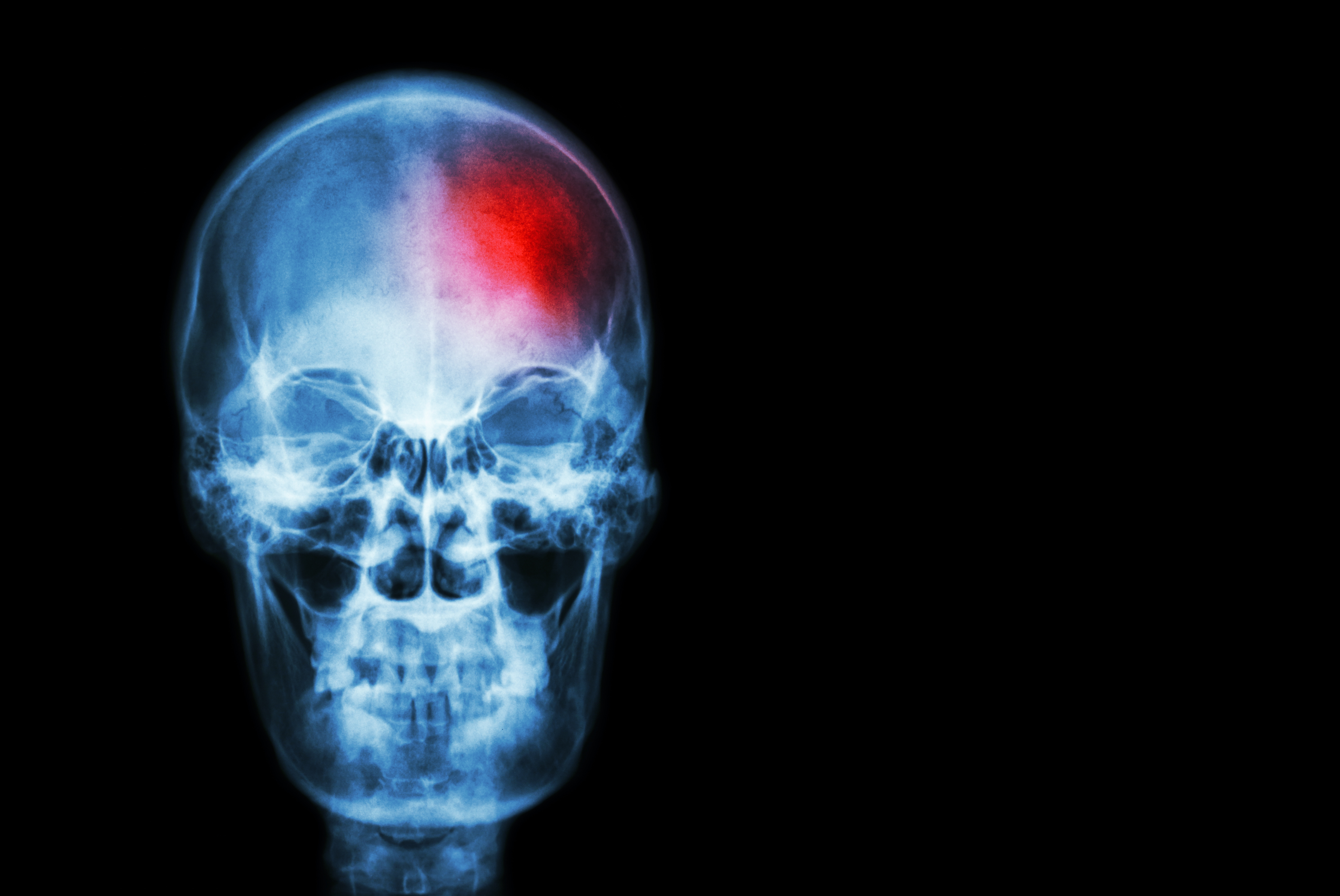 L'inflammation dans le cerveau peut être plus largement impliquée dans les démences qu'on ne le pensait