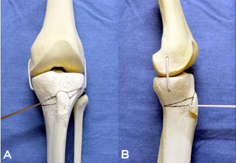 De nouvelles données engagent à opter plus souvent pour l'ostéotomie tibiale haute, ce qui peut permettre de retarder ou d’éliminer la nécessité d'une arthroplastie totale du genou (Visuel NIH)