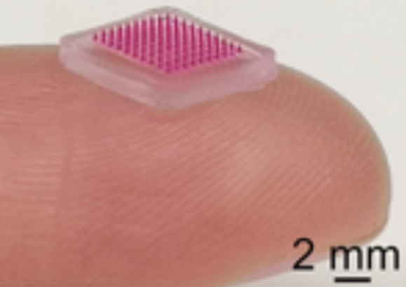 Ce patch « microneedle » ou microaiguilles va permettre de délivrer des antibiotiques localement par voie cutanée et de limiter ainsi les traitements systémiques (Visuel Institut Karolinska ) .