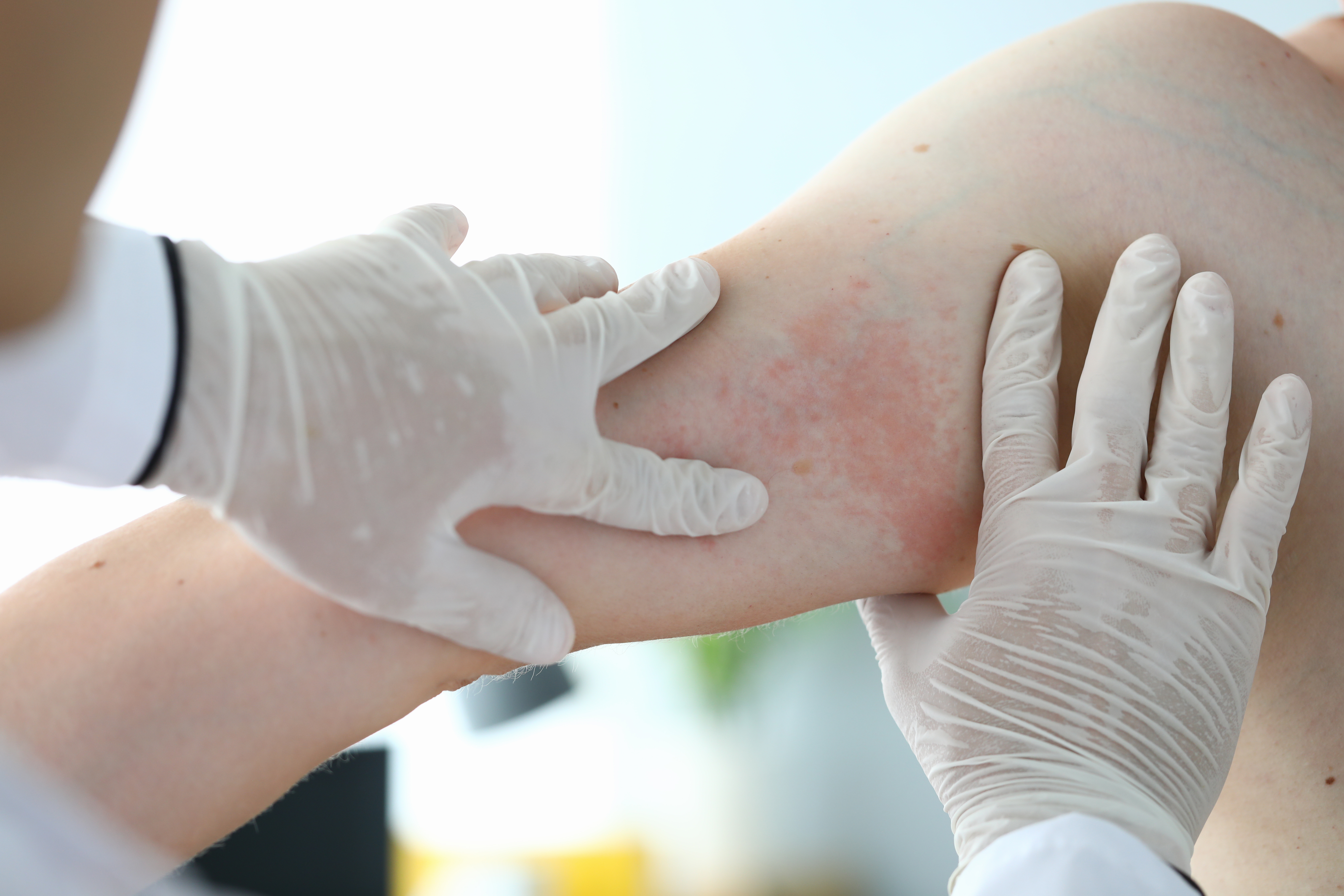 Cibler une protéine spécifique de la peau peut aider à contrôler l'inflammation associée au psoriasis (Visuel adobe Stock 321863066)