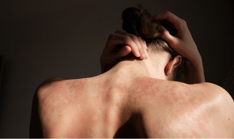 Le psoriasis se définit comme une maladie chronique de la peau qui perturbe le renouvellement des cellules cutanées (Visuel @ Rocketlinks)