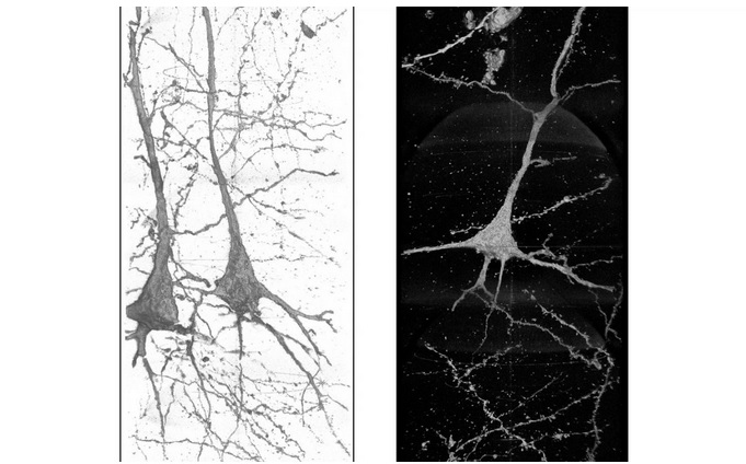 Les structures de ces neurones sont différentes et uniques chez chaque patient schizophrène, ce qui suggère que la maladie est associée à ces différences structurelles (Visuel Ryuta Mizutani)