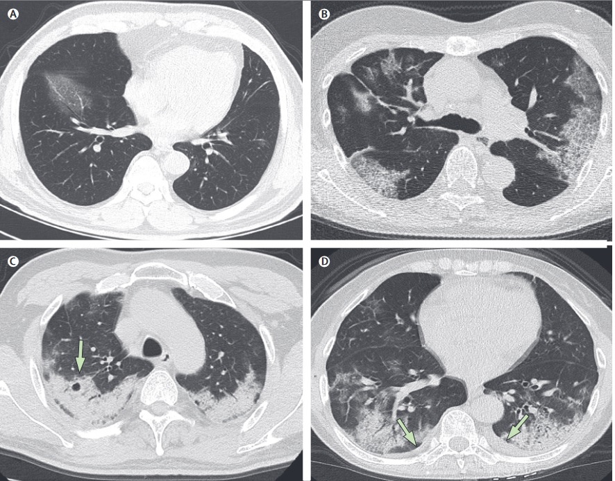 Images thoraciques de 2 patients infectés