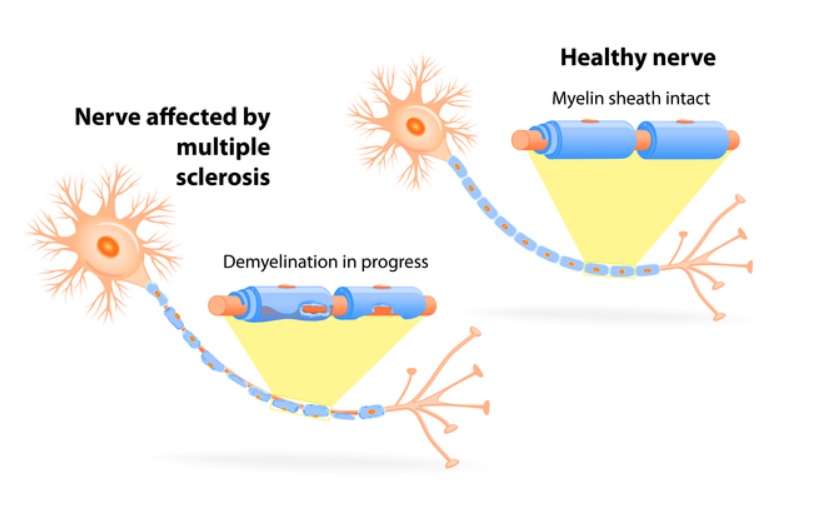 Epuiser la protéine reeline pourrait protéger contre plusieurs conditions caractérisées par une inflammation chronique (visuel CDC)