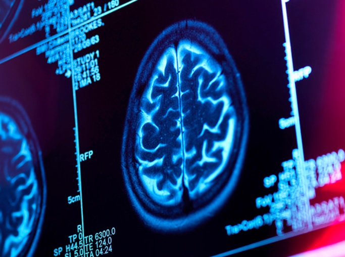 La stimulation cérébrale profonde de la zone cérébrale liée à la récompense et à la motivation est une thérapie prometteuse pour la dépression résistante au traitement (Visuel NIH).