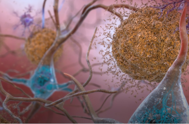 Plutôt que de démarrer dans un site bien précis du cerveau, les protéines toxiques forment des agrégats un peu partout, entraînant une progression plutôt multisite mais lente de la maladie (Visuel Université du Colorado) Plutôt que de démarrer dans un site bien précis du cerveau, les protéines toxiques forment des agrégats un peu partout, entraînant une progression plutôt multisite mais lente de la maladie (Visuel Université du Colorado)
