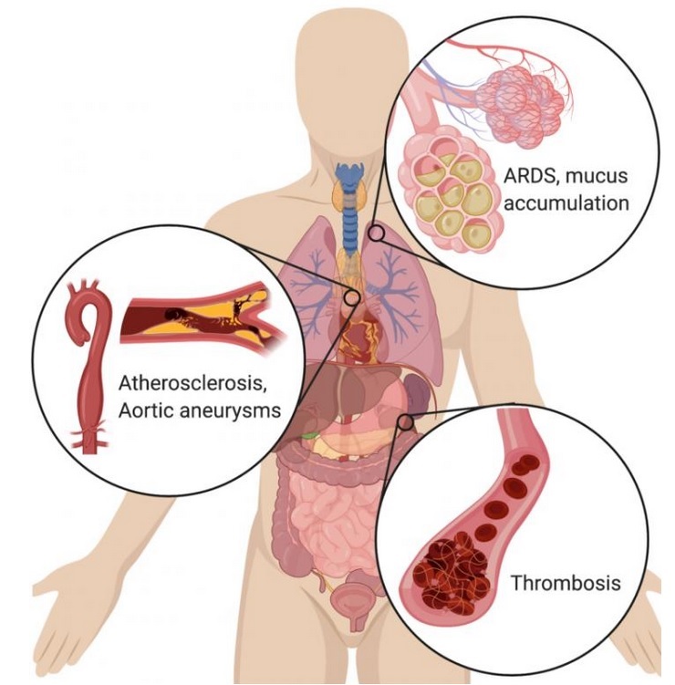Ce médicament, le défibrotide, aide à échapper à un des effets néfastes induit par la réponse immunitaire excessive, la formation de caillots (Visuel Fotolia) Ce médicament, le défibrotide, aide à échapper à un des effets néfastes induit par la réponse immunitaire excessive, la formation de caillots (Visuel Fotolia)
