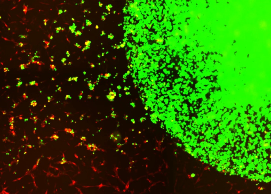 Il s'agit d'une nouvelle thérapie cellulaire standard pour cibler et tuer les cellules tumorales restantes dans le cerveau, après la chirurgie, chez les patients atteints de glioblastome (Visuel Shah lab (CSTI))