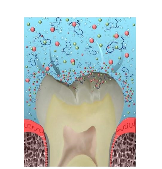 Un nouveau composite, ou un nouveau dentifrice préventif illustreront bientôt cette alternative aux soins actuels : la reminéralisation guidée par les peptides.