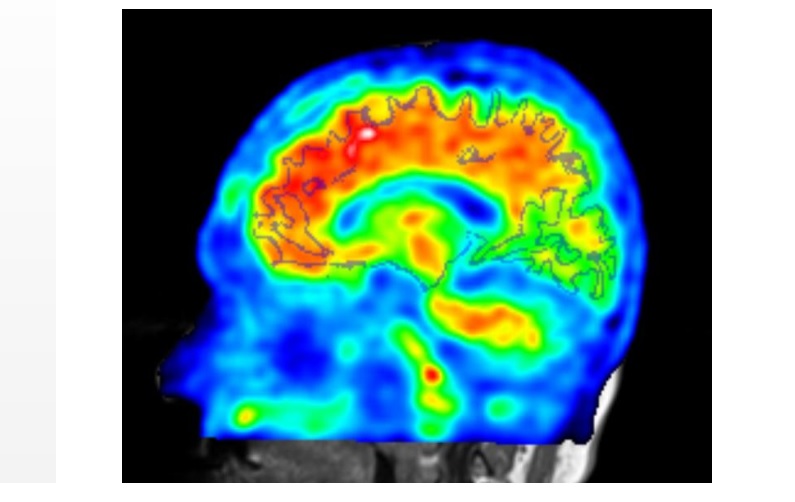 Les patients positifs à l'imagerie « bêta-amyloïde » étaient également ceux commettant un nombre significativement plus élevé d'erreurs d'intrusion sémantique.