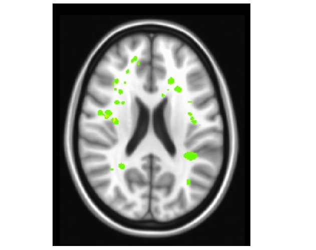 Les AVC silencieux (en vert clair sur visuel) ont aussi des effets débilitants sur la fonction exécutive, sur la capacité du cerveau à exécuter des tâches complexes nécessaires pour le maintien d'un travail ou la réussite scolaire. 