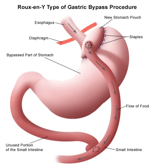 La chirurgie de pontage gastrique peut apporter un meilleur contrôle du diabète et de l'obésité que la modification du mode de vie