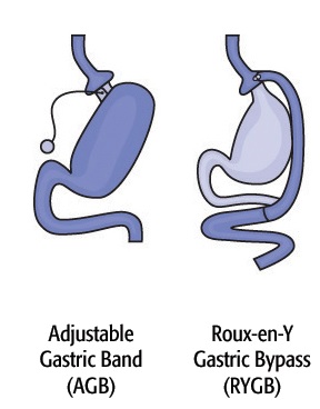 Ces 2 types de chirurgie peuvent changer radicalement la sensibilité et l'absorption d'alcool