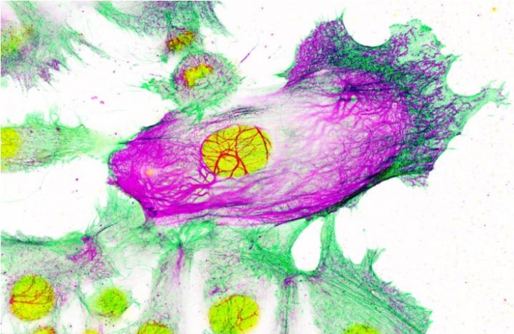 Cette nanocapsule est capable de cibler et d’atteindre un cancer qui s'est propagé au système nerveux central Cette nanocapsule est capable de cibler et d’atteindre un cancer qui s'est propagé au système nerveux central