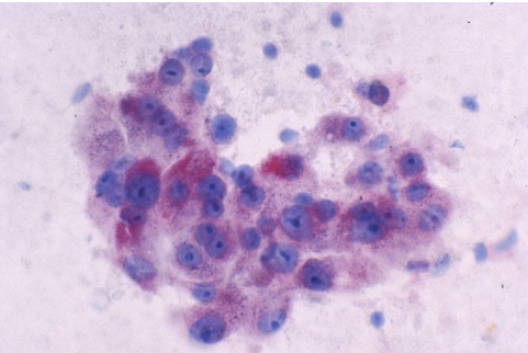 ce type d’immunothérapie qui vise à aider l'organisme à tuer les cellules cancéreuses grâce à la réponse immunitaire, lorsque qu’elle fonctionne, est très efficace mais, malheureusement, dans la réalité souvent inefficace... 