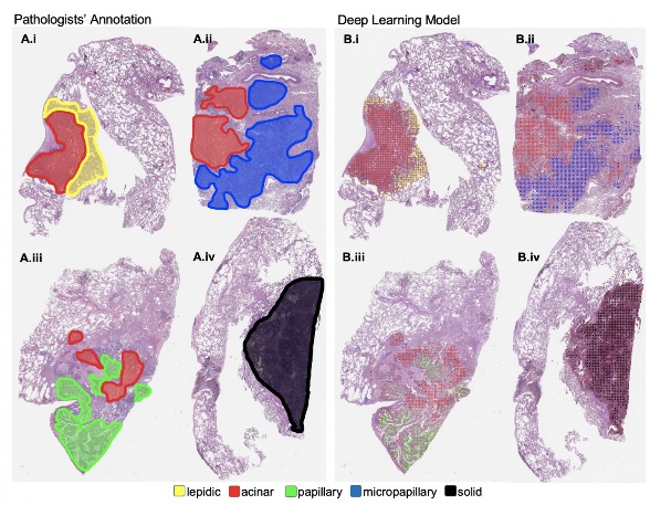 C’est une première démonstration de la performance élevée de l'apprentissage automatique dans le cadre d'une tâche de classification d'images complexes et des applications possibles dans le diagnostic des cancers, mais pas seulement. 