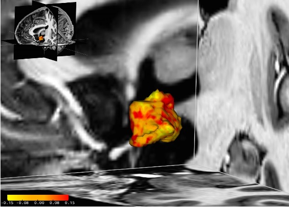 Chez ces patientes dépressives, les zones de l'hypothalamus (en rouge sur visuel) sont plus développées que chez leurs homologues en bonne santé.