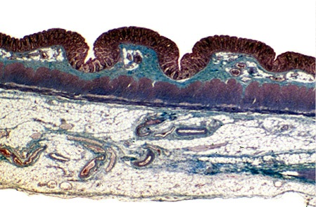 Ces travaux identifient une cytokine, qui connue pour supprimer l'inflammation, à des niveaux élevés favorise le développement du cancer. Ces travaux identifient une cytokine, qui connue pour supprimer l'inflammation, à des niveaux élevés favorise le développement du cancer.