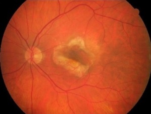 Alors que la formation excessive de vaisseaux sanguins (angiogenèse) dans l'œil est impliquée dans la dégénérescence maculaire liée à l'âge, la rétinopathie diabétique proliférante, le glaucome néovasculaire et la rétinopathie des prématurés, des causes majeures de cécité, les isoflavonoïdes d'origine naturelle -ici extraits de plantes la famille des Hyacinthaceae, confirment ici une capacité antiproliférative puissante dans les cellules endothéliales et un fort potentiel anti-angiogénique in vitro et in vivo. Alors que la formation excessive de vaisseaux sanguins (angiogenèse) dans l'œil est impliquée dans la dégénérescence maculaire liée à l'âge, la rétinopathie diabétique proliférante, le glaucome néovasculaire et la rétinopathie des prématurés, des causes majeures de cécité, les isoflavonoïdes d'origine naturelle -ici extraits de plantes la famille des Hyacinthaceae, confirment ici une capacité antiproliférative puissante dans les cellules endothéliales et un fort potentiel anti-angiogénique in vitro et in vi