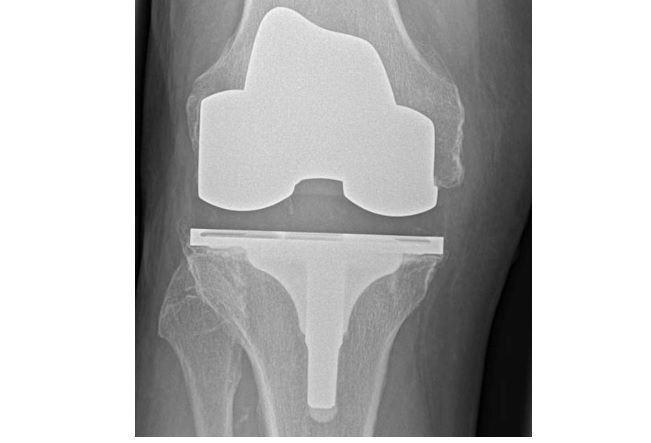 80% des arthroplasties du genou et 60% des arthroplasties de la hanche sont toujours en place après 25 ans.