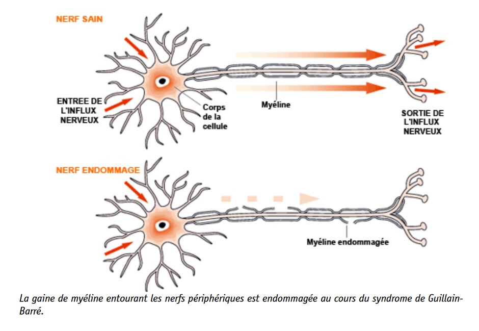 Une association forte entre une infection au COVID-19 et le syndrome de Guillain-Barré. apparaît peu mprobable (Schéma Orphanet)