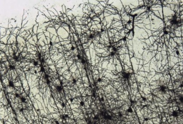 Environ 40% des patients atteints de la maladie de cette pathologie neurodégénérative présentent aussi des symptômes de dépression, et même à un stade précoce avant même l'apparition des symptômes moteurs typiques de la maladie. Environ 40% des patients atteints de la maladie de cette pathologie neurodégénérative présentent aussi des symptômes de dépression, et même à un stade précoce avant même l'apparition des symptômes moteurs typiques de la maladie.