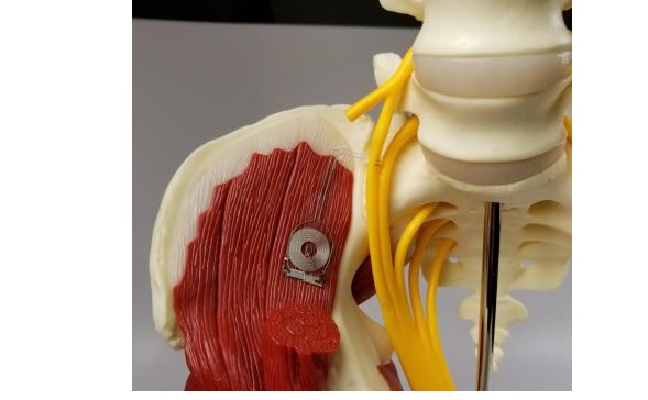 L'implant biodégradable fournit une stimulation électrique pour accélérer la régénération et améliorer la guérison d'un nerf endommagé. 