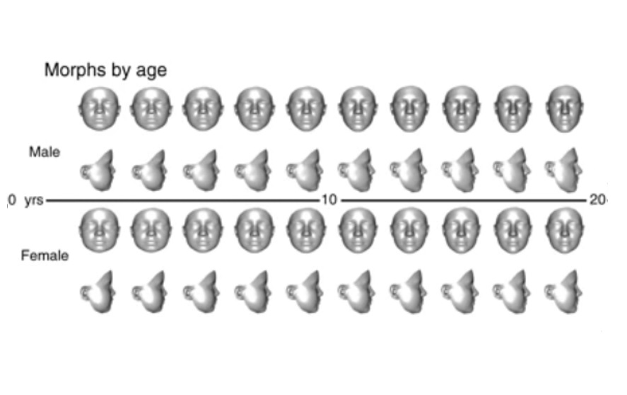 L'analyse faciale en 3D pourrait permettre d’accélérer la détection et le diagnostic des maladies rares chez l’Enfant. (Visuel Genetics in Medicine)