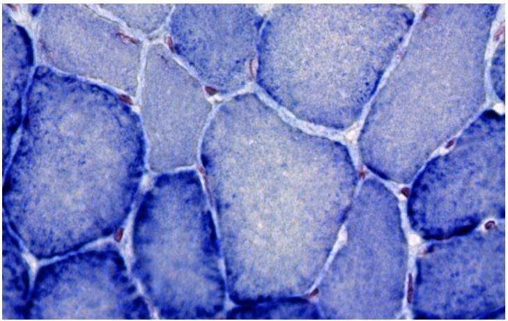 De premiers résultats d’efficacité prometteurs du tamoxifène apportent l’espoir d’un premier traitement contre la myopathie myotubulaire De premiers résultats d’efficacité prometteurs du tamoxifène apportent l’espoir d’un premier traitement contre la myopathie myotubulaire